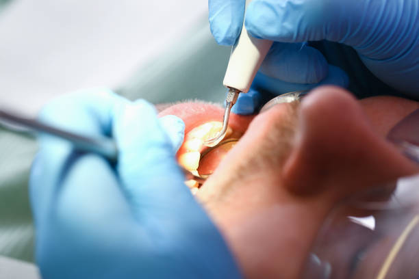 Best Emergency Tooth Extraction in Arcadia, LA
