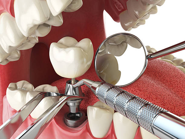 Best Emergency Wisdom Teeth Removal in Arcadia, LA